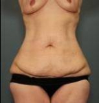 ABDOMINOPLASTY POST MASSIVE WEIGHT LOSS: Case 43 Before
